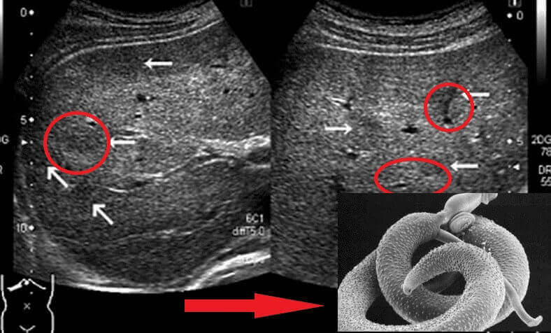Intestinal parasites